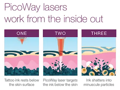 Candela PicoWay Laser Tattoo Removal in Colorado Springs