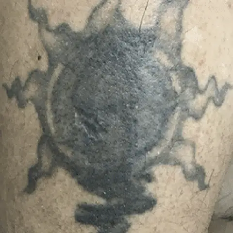 PicoWay® Laser Tattoo Removal Before Treatment | Mountain Edge CO