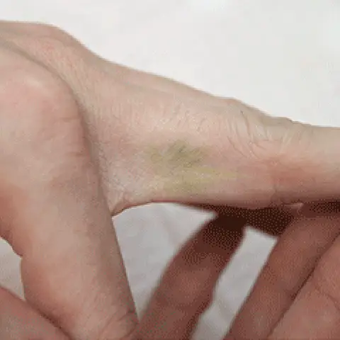 PicoWay® Laser Tattoo Removal After Treatment | Mountain Edge CO