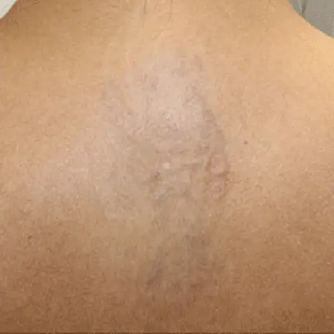 PicoWay® Laser Tattoo Removal After Treatment | Mountain Edge CO