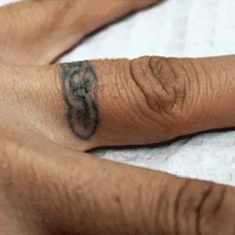 PicoWay® Laser Tattoo Removal Before Treatment | Mountain Edge CO