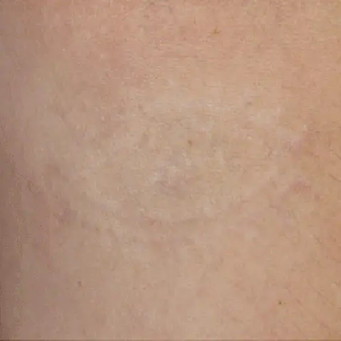 PicoWay® Laser Tattoo Removal After Treatment | Mountain Edge CO