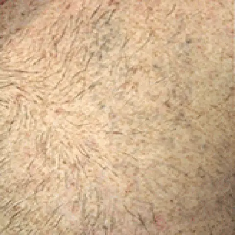 PicoWay® Laser Tattoo Removal After Treatment | Mountain Edge CO