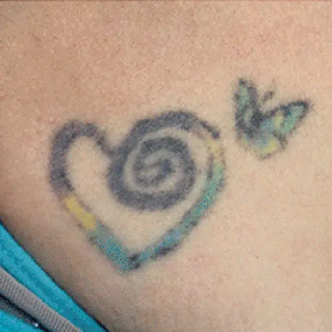 PicoWay® Laser Tattoo Removal Before Treatment | Mountain Edge CO