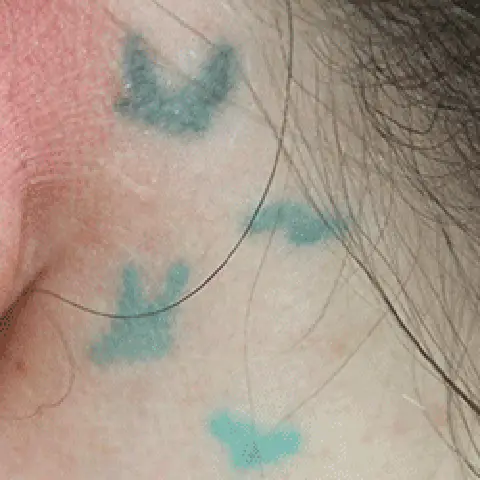 PicoWay® Laser Tattoo Removal Before Treatment | Mountain Edge CO
