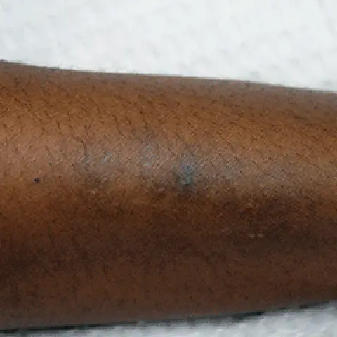 PicoWay® Laser Tattoo Removal After Treatment | Mountain Edge CO