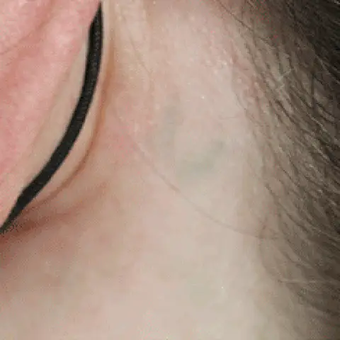 PicoWay® Laser Tattoo Removal After Treatment | Mountain Edge CO