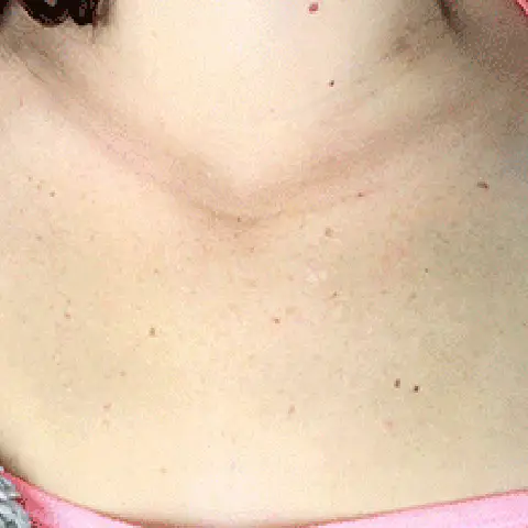 PicoWay® Laser Tattoo Removal After Treatment | Mountain Edge CO