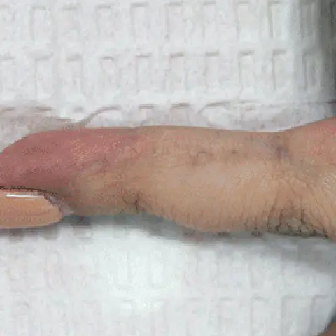 PicoWay® Laser Tattoo Removal After Treatment | Mountain Edge CO