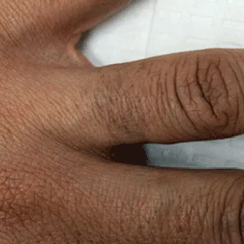 PicoWay® Laser Tattoo Removal After Treatment | Mountain Edge CO