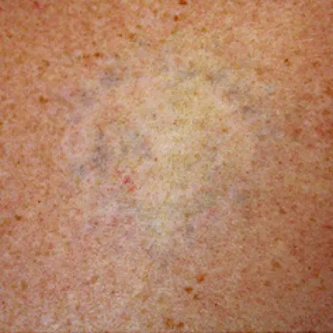 PicoWay® Laser Tattoo Removal After Treatment | Mountain Edge CO