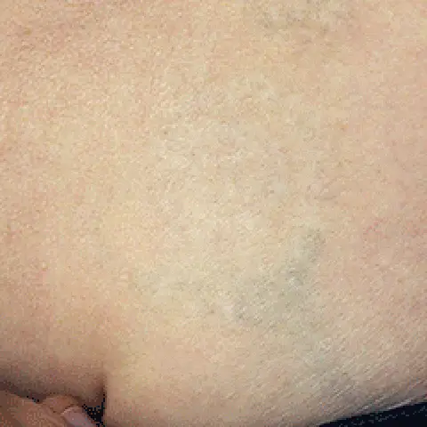 PicoWay® Laser Tattoo Removal After Treatment | Mountain Edge CO