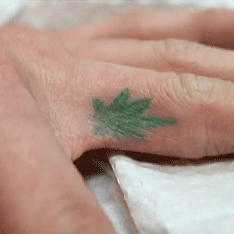 PicoWay® Laser Tattoo Removal Before Treatment | Mountain Edge CO