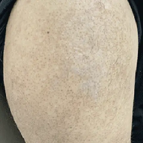 PicoWay® Laser Tattoo Removal After Treatment | Mountain Edge CO