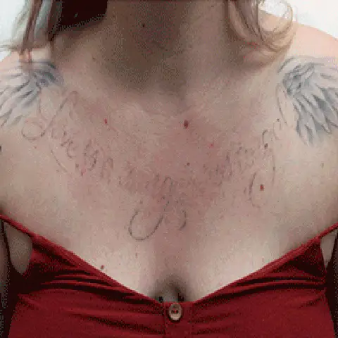 PicoWay® Laser Tattoo Removal After Treatment | Mountain Edge CO