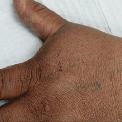 PicoWay® Laser Tattoo Removal After Treatment | Mountain Edge CO