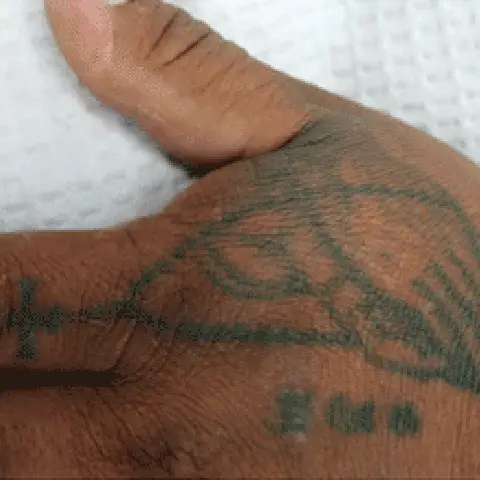 PicoWay® Laser Tattoo Removal Before Treatment | Mountain Edge CO