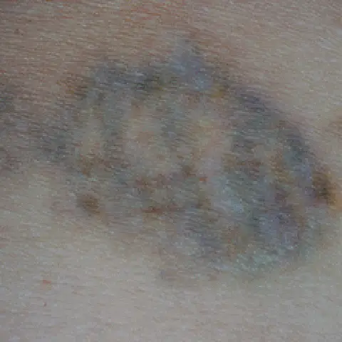 PicoWay® Laser Tattoo Removal After Treatment | Mountain Edge CO