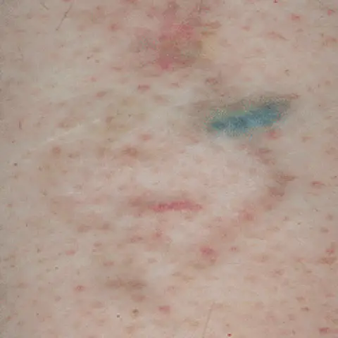 PicoWay® Laser Tattoo Removal After Treatment | Mountain Edge CO