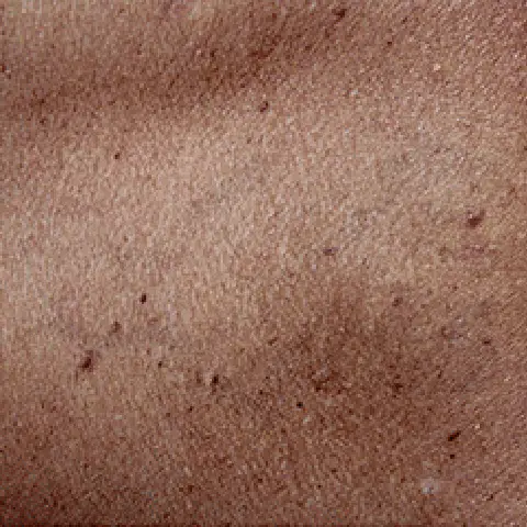 PicoWay® Laser Tattoo Removal After Treatment | Mountain Edge CO