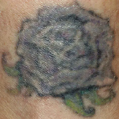 PicoWay® Laser Tattoo Removal After Treatment | Mountain Edge CO