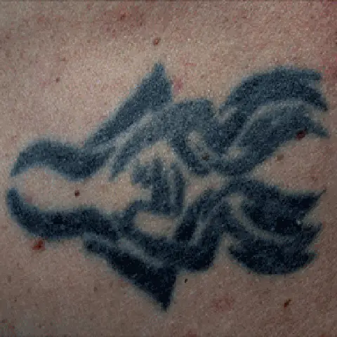 PicoWay® Laser Tattoo Removal Before Treatment | Mountain Edge CO