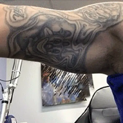 PicoWay® Laser Tattoo Removal Before Treatment | Mountain Edge CO