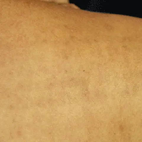 PicoWay® Laser Tattoo Removal After Treatment | Mountain Edge CO