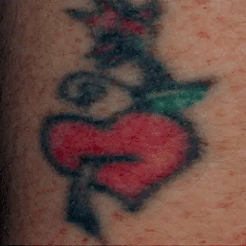 PicoWay® Laser Tattoo Removal Before Treatment | Mountain Edge CO