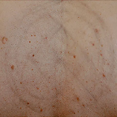 PicoWay® Laser Tattoo Removal After Treatment | Mountain Edge CO