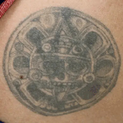 PicoWay® Laser Tattoo Removal Before Treatment | Mountain Edge CO