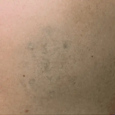 PicoWay® Laser Tattoo Removal After Treatment | Mountain Edge CO