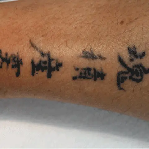 PicoWay® Laser Tattoo Removal Before Treatment | Mountain Edge CO