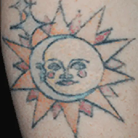 PicoWay® Laser Tattoo Removal After Treatment | Mountain Edge CO