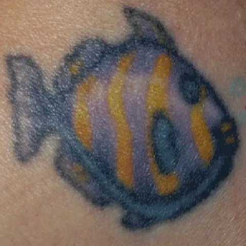 PicoWay® Laser Tattoo Removal Before Treatment | Mountain Edge CO