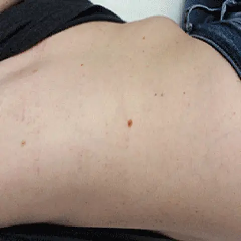 PicoWay® Laser Tattoo Removal After Treatment | Mountain Edge CO