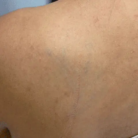 PicoWay® Laser Tattoo Removal After Treatment | Mountain Edge CO