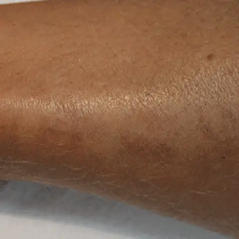 PicoWay® Laser Tattoo Removal After Treatment | Mountain Edge CO