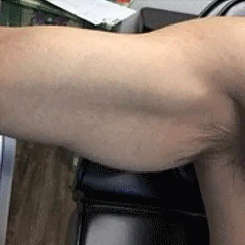 PicoWay® Laser Tattoo Removal After Treatment | Mountain Edge CO