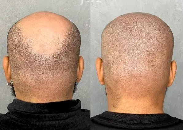 Effet crâne rasé tricopigmentation Bordeaux