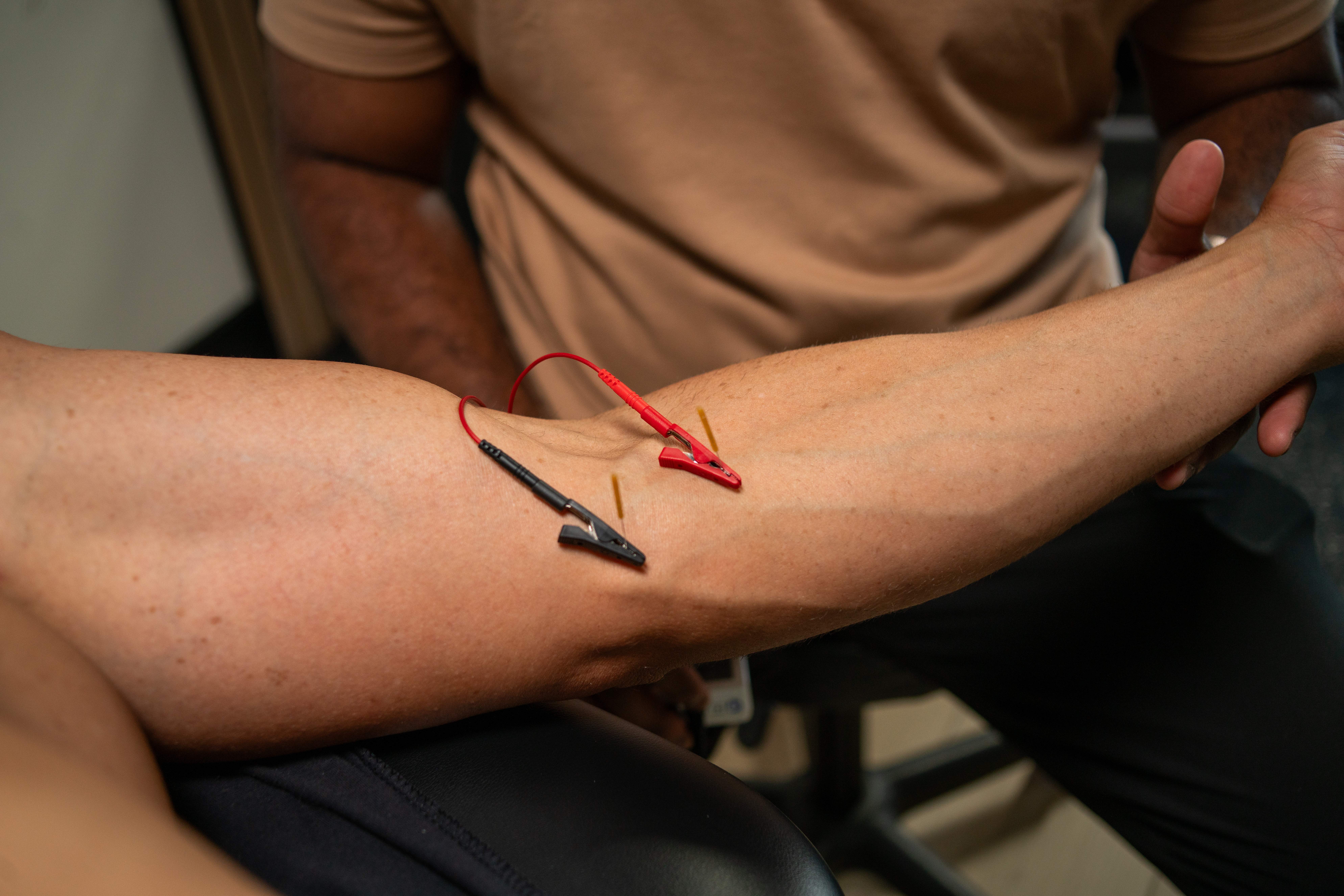 Dry Needling