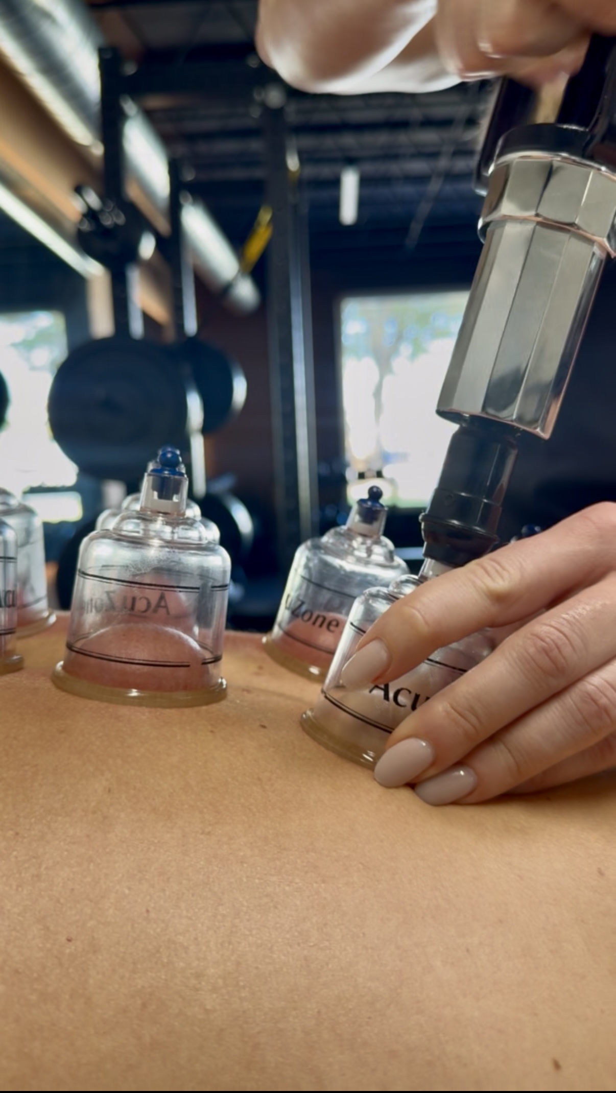 Cupping therapy session at Revive Physiotherapy