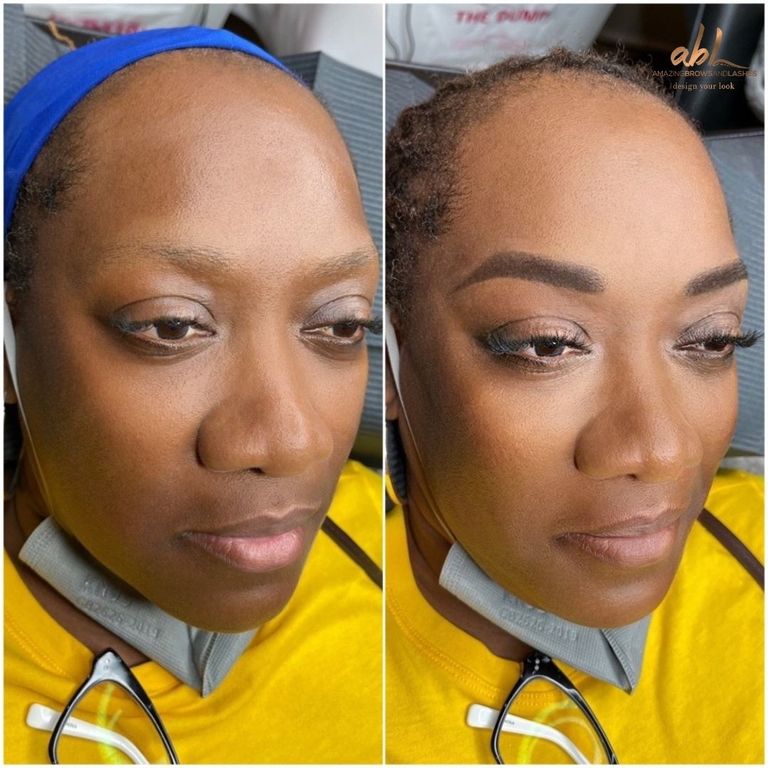 Brow before and after