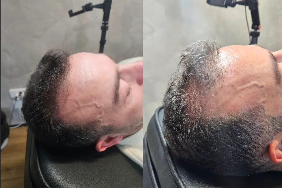 Tricopigmentation avant après, densification capillaire – Blush France Bordeaux
