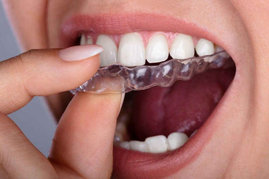 Clear aligner being placed over teeth