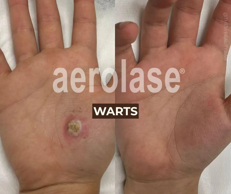 Aerolase before and after example for warts