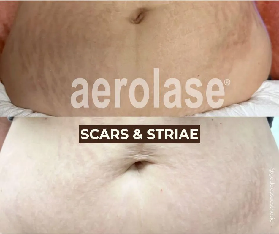 Aerolase before and after example for scars and stretch marks