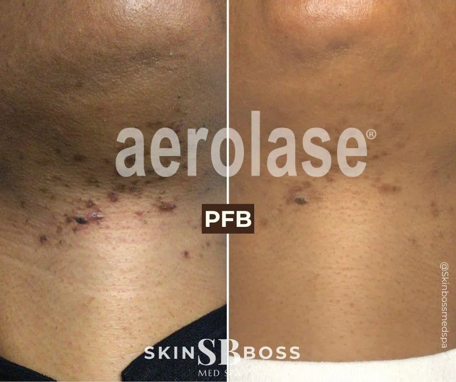 Aerolase before and after example for ingrown hair and PFB