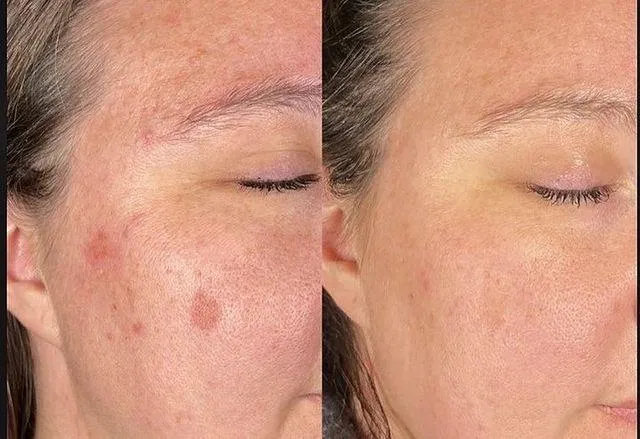 Aerolase before and after example for hyperpigmentation and dark spots