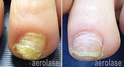Aerolase before and after example for nail fungus